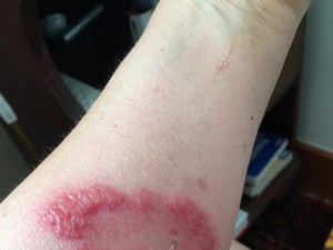 Vigyázat! Ezek az iPhone tokok égési sérüléseket okoztak!