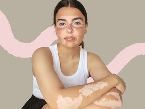 Ezt üzeni a tested, amikor pigmenthiányt, azaz vitiligót tapasztalsz