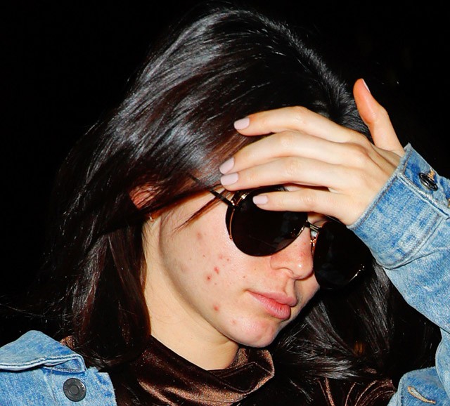 Kendall Jenner pattanásos