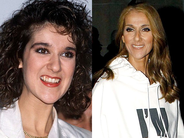 Előtte-utána: sztárok, akik megcsináltatták a fogukat