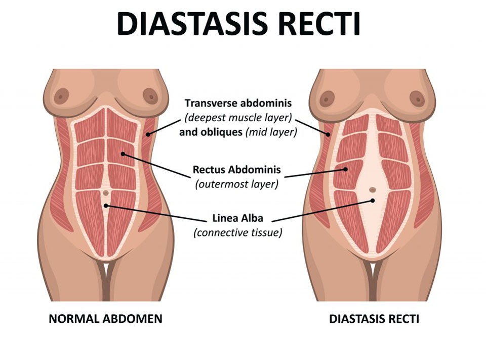 Front plank a szülés után - miért várj vele?