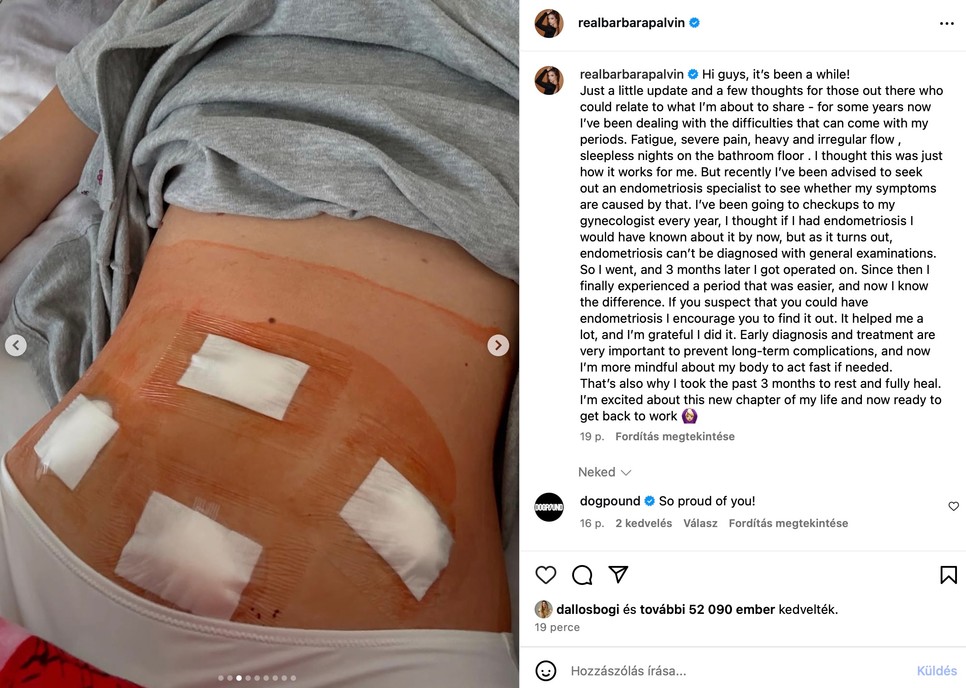 Műtét utáni fotókat mutatott Palvin Barbara