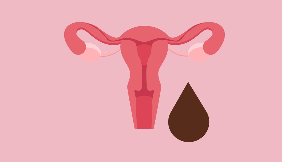  A vér barna színe mást jelent a menstruáció végén és a pedióduasid között