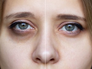 Ezt csináld a szem alatti karikák ellen!