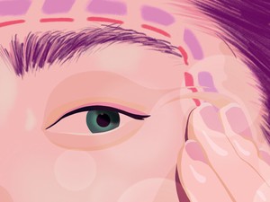 Filler-teória: tudj meg többet az esztétikai és plasztikai beavatkozásokról!