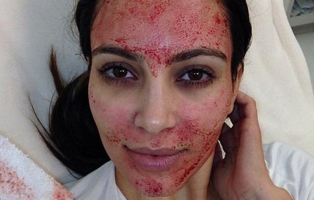 Kim Kardashian a vámpír-kezelésen