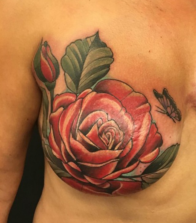 Mellműtét hegeinek takarása