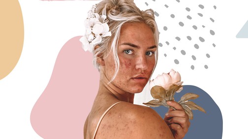 Meglepő, de ezek a dolgok pattanást okozhatnak!