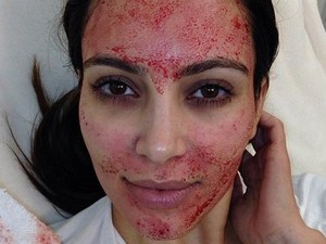 Horror: a második nő lett HIV-fertőzött a népszerű kozmetikai kezelés után