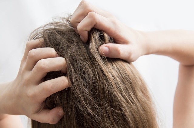 Rettenetesen viszket a fejbőröd? Ez lehet akár ekcéma is