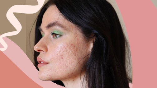 9 példamutató influenszer, aki elfogadja bőrét úgy, ahogy van