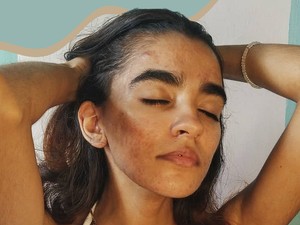 3 típusú hormonális változás, ami rossz hatással van a bőrödre