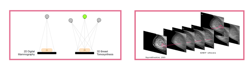 2D mammográfia vs. 3D tomoszintézis