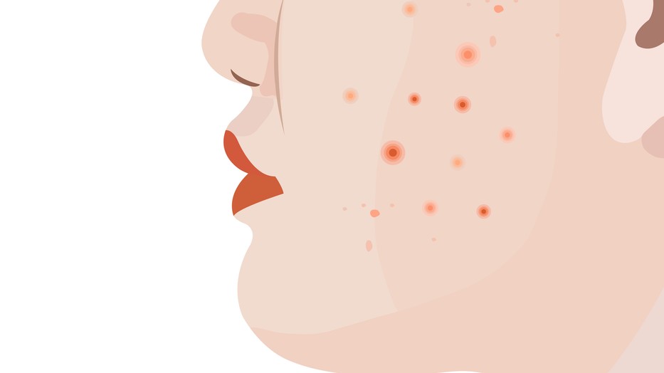 A pattanások bármilyen életkorban megjelenhetnek az arcodon, valamilyen problémát jeleznek, ami után kutakodnod kell orvosok segítségével