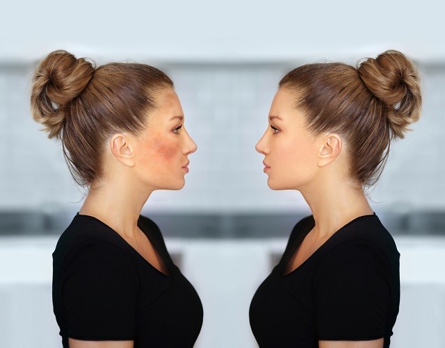 Barna foltok jelentek meg a bőrödön? Hagyd a tejfölt, van rá profi otthoni megoldás!