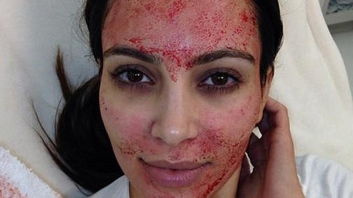 Horror: a második nő lett HIV-fertőzött a népszerű kozmetikai kezelés után