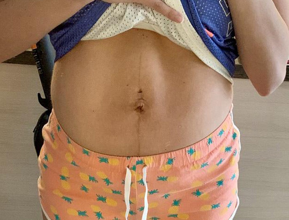  A szétnyílt hasizom az esetek többségében megelőzhető!