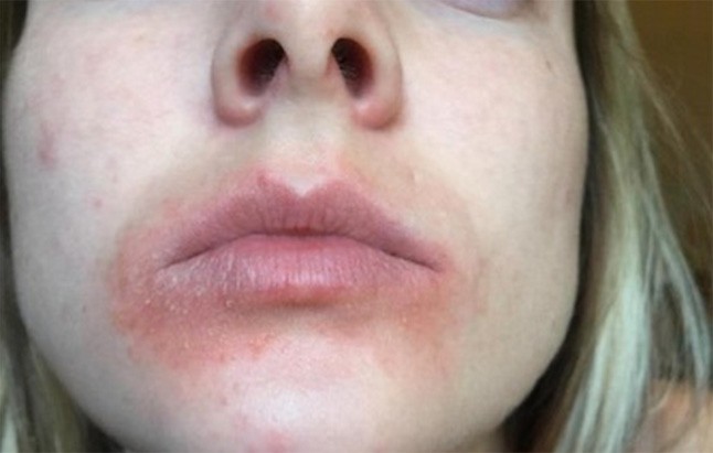Sokkoló kép! Vérzés, kiütések - ezt okozza a menő ajakbalzsam