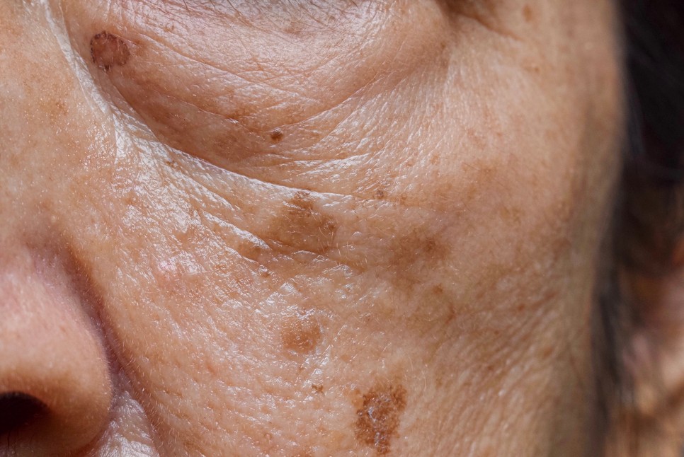 Az idő előrehaladtával a bőrszín fakóvá válik, a festéktermelődés pedig egyenetlen lesz