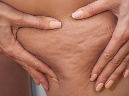 Orvosi oka van, hogy a nőknek miért keletkezik narancsbőrük