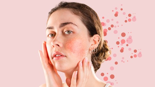 Lehet, hogy a te arcod is a  rosacea miatt piros? A szakértő minden kérdésedre választ ad
