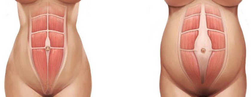  A várandósság idején a szétnyílt hasizom természetes jelenség