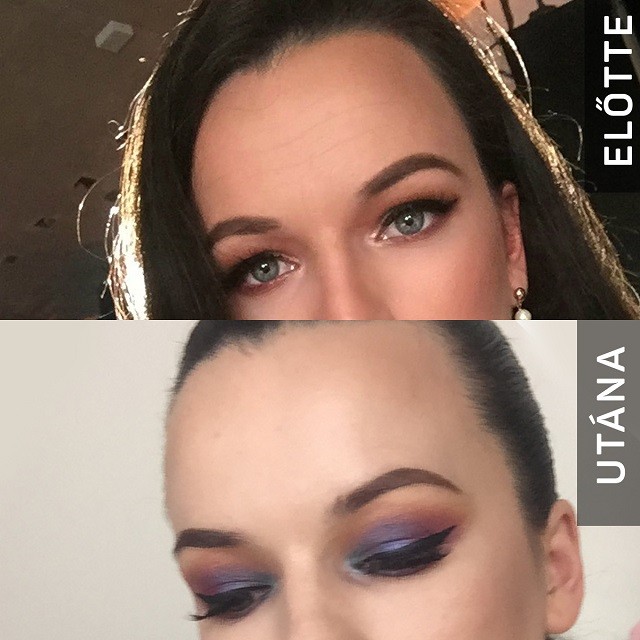 Faarc helyett felszabadult mosoly: Így működik a botox és a hiarulonsav!