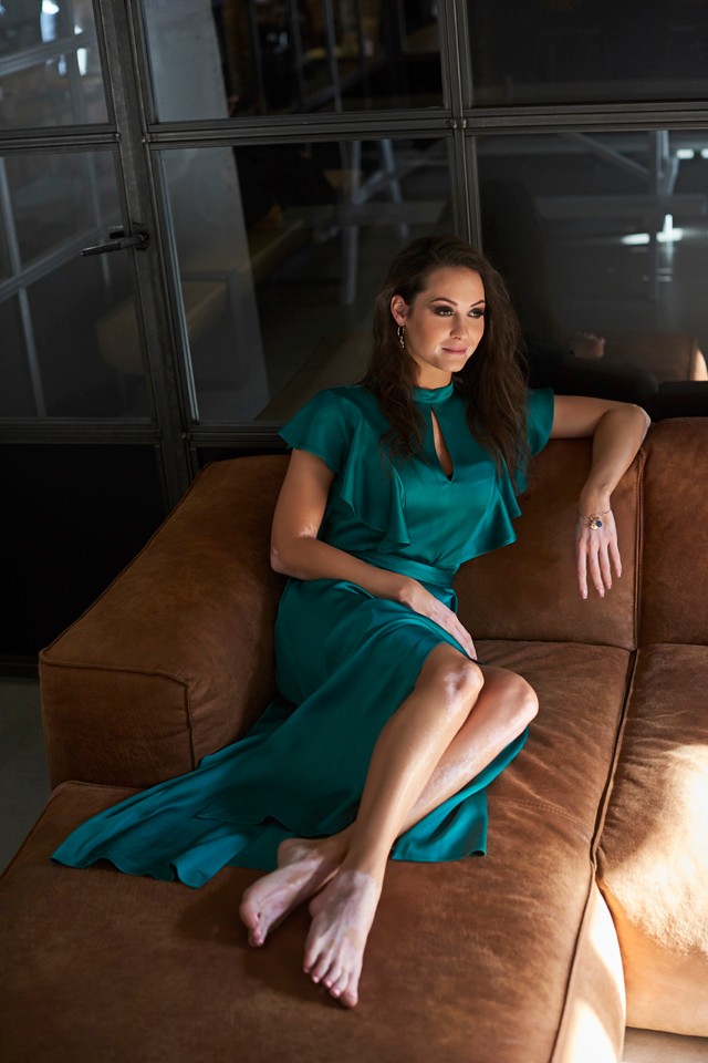 Így élek együtt a vitiligóval - Széles Adriennt nem foghatja vissza semmi