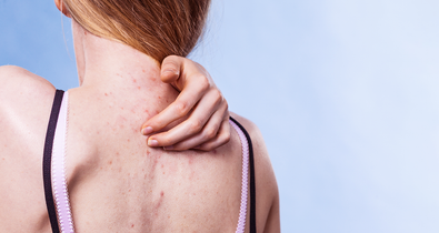 Így szabadulj meg az idegesítő pattanásoktól a hátadon