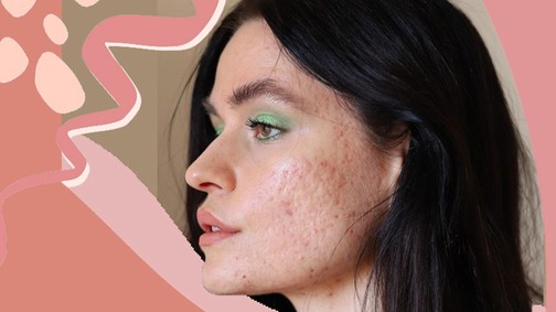 5 dolog, amit bárcsak tudtam volna a pattanásokról 18 évesen