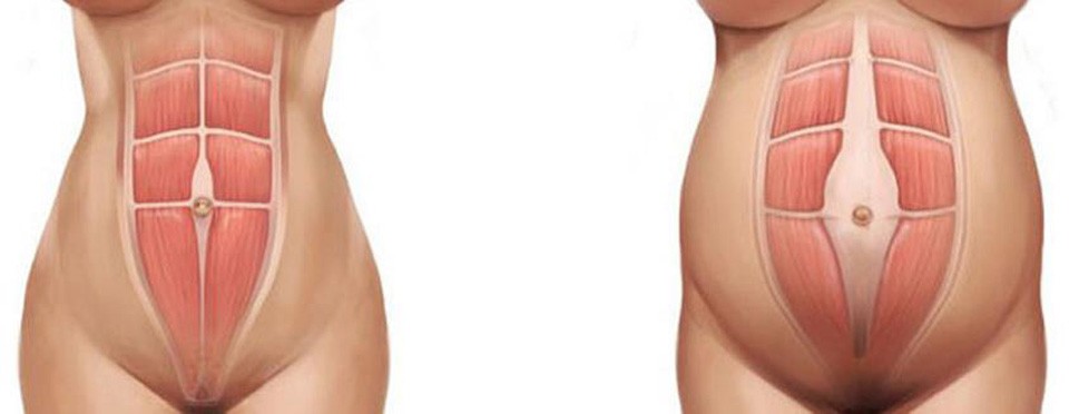  A várandósság harmadik trimeszterében normális, ha a hasizom két oldala eltávolodik egymástól