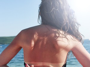 Ezért ne kotyvassz otthon SOHA napvédő krémet