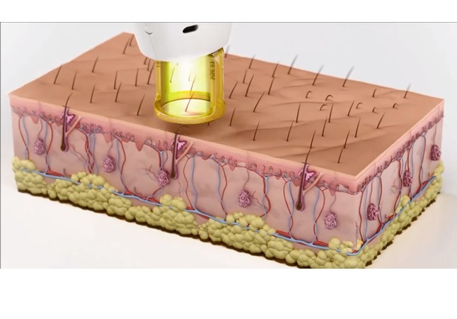 Lola is a végleges megoldásra szavazott