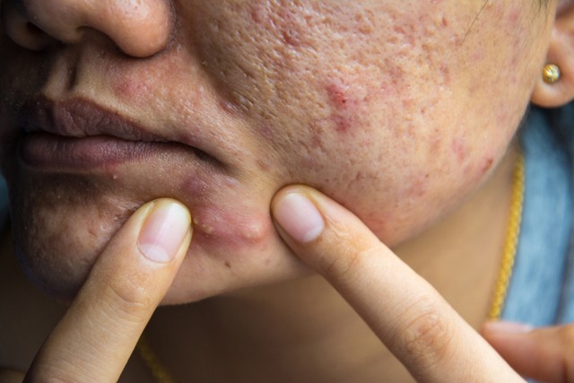 9 pattanás, amit SOHA nem szabad kinyomni