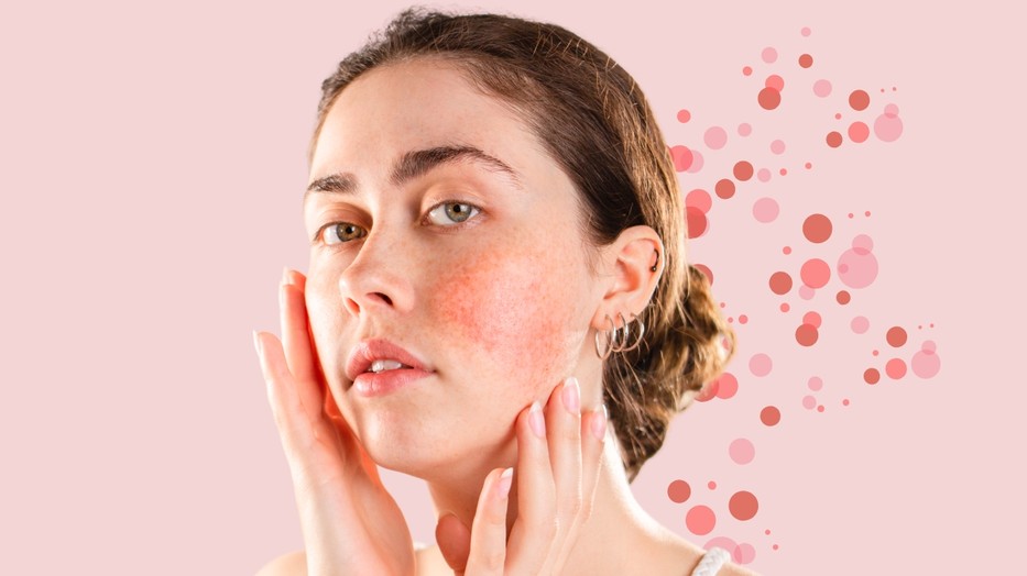 Szakértő elárulja, mi a különbség a rosacea és a bőrpír között, és hogyan kezelheted őket