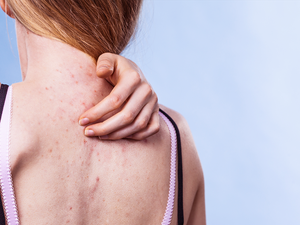 Így szabadulj meg az idegesítő pattanásoktól a hátadon