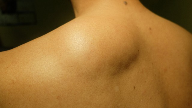 9 pattanás, amit SOHA nem szabad kinyomni