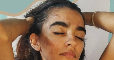 3 típusú hormonális változás, ami rossz hatással van a bőrödre