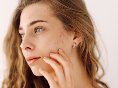 5 pattanás típus, amit soha nem szabad kinyomni