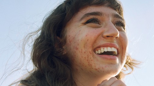 Harcban a bőröddel: 3 nő, különböző bőrproblémákkal - mit mond a szakértő?