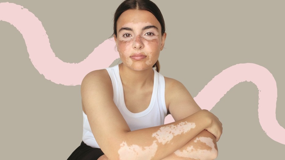 Tudtad, hogy a vitiligo kialakulásának lelki okai is lehetnek? - Fotó: Rab Roland, Stylist: Csillag Szilvia, Smink és haj: Nógrádi Barbara, Modell: Riancázev Zsanett Regina