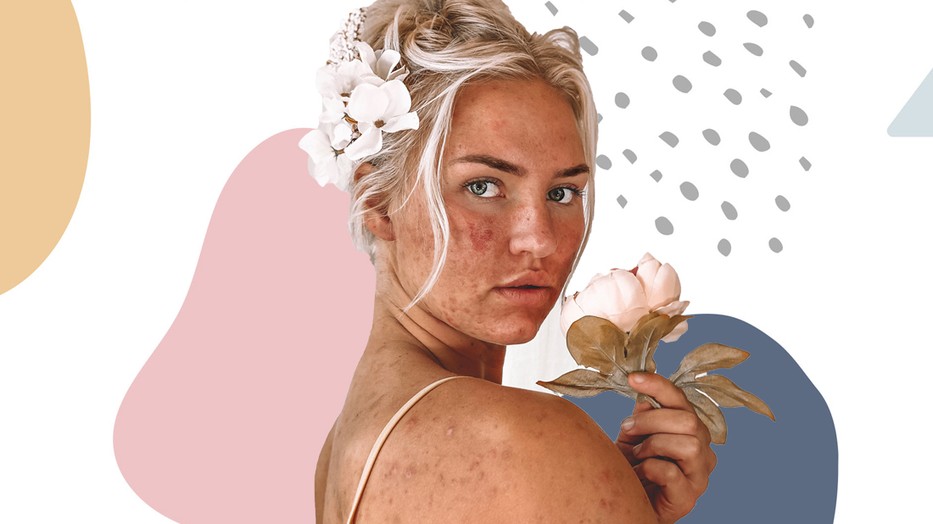 Meglepő, de ezek a dolgok pattanást okozhatnak!