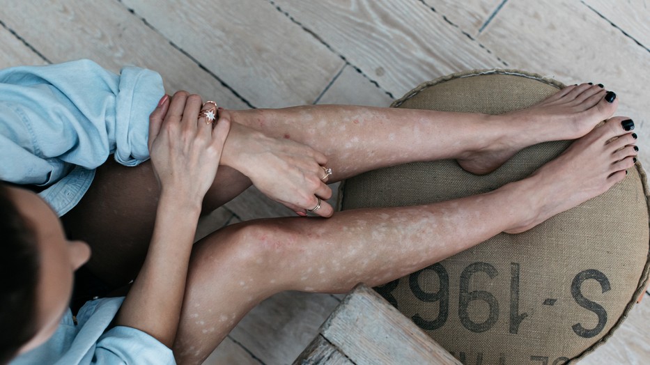 A pszoriázis nagyon gyakori betegség, ha ezzel küzdesz, ne szégyeld magad miatta, hanem tudd, hogy abszolút nem vagy egyedül!