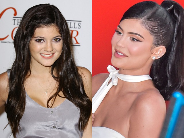 Előtte-utána: sztárok, akik megcsináltatták a fogukat