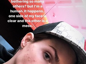 Megdöbbentő, de lehet, hogy te is azért vagy pattanásos, mint a színésznő