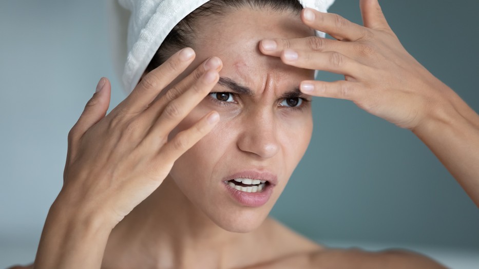 Problémás a bőröd? Itt a megoldás!