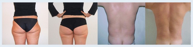 Végleges zsíreltávolítás vágás nélkül