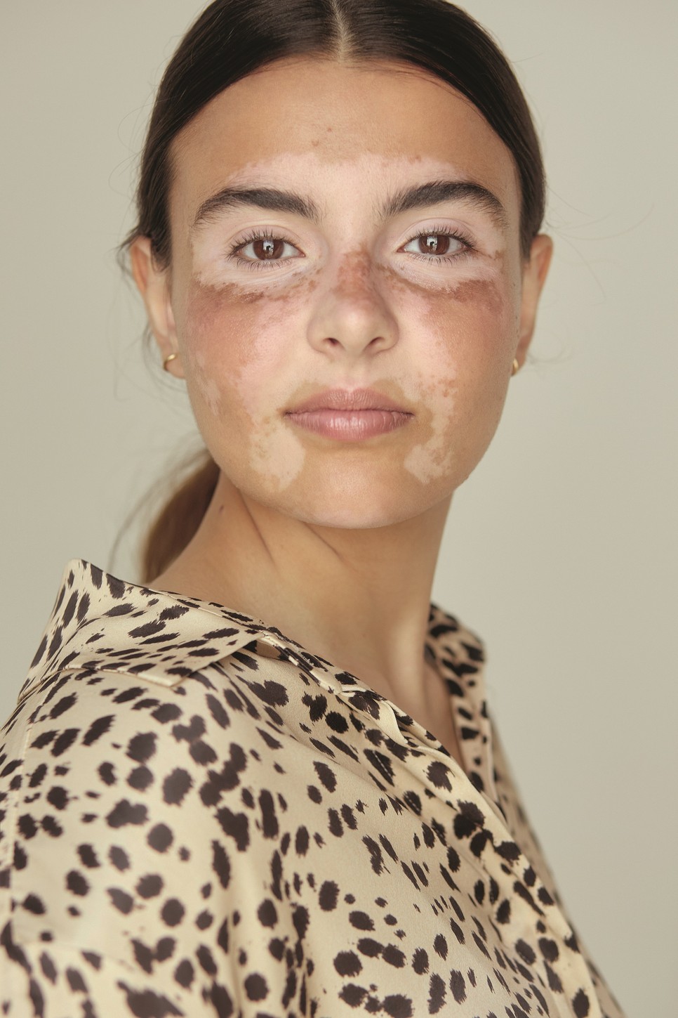 A vitiligo megjelenése erősen hat az önértékelésre