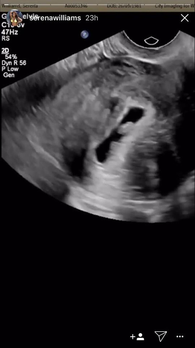 Már tudjuk Serena Williams babájának nevét!