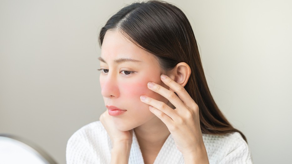 A rosacea értést és nem fedést kíván 
